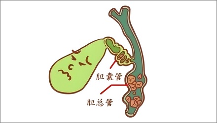 不吃早饭的人更容易得胆结石？