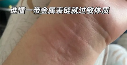 为什么金属过敏的人，只对金子不过敏？