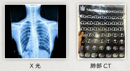 为什么拍了片子还要做 CT，做了 CT 又要上核磁共振？