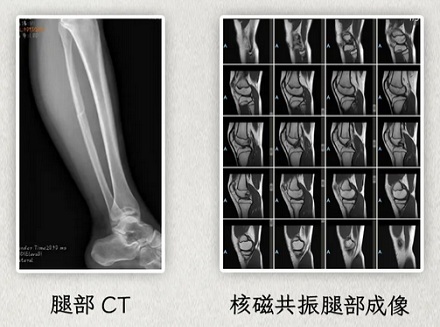 为什么拍了片子还要做 CT，做了 CT 又要上核磁共振？