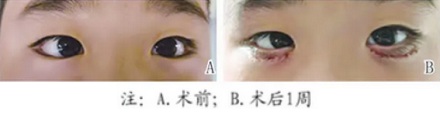 为什么眼上得了这种病，医生会建议你割个双眼皮？