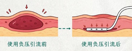做手术时，为什么有些时候医生要给患者「上个手榴弹」？